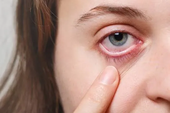 Close-up of a red, inflamed eye being held open