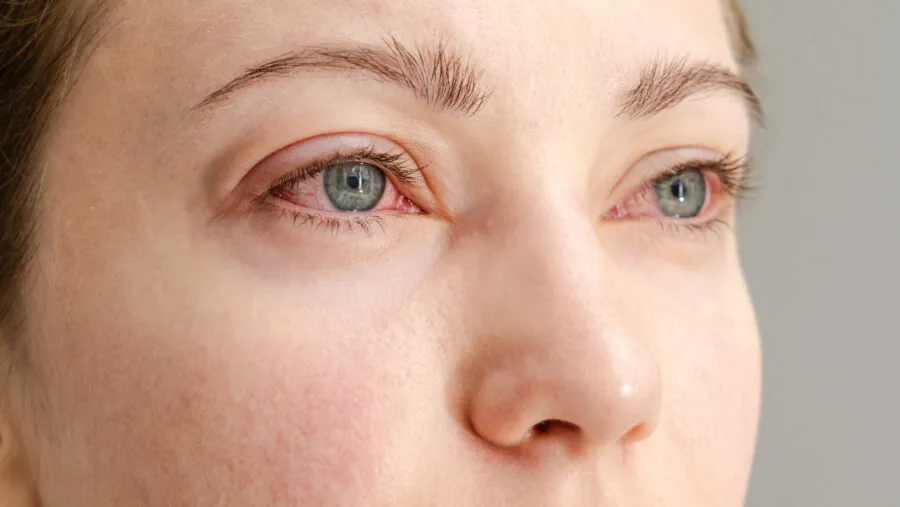 Close-up of both eyes looking red and irritated