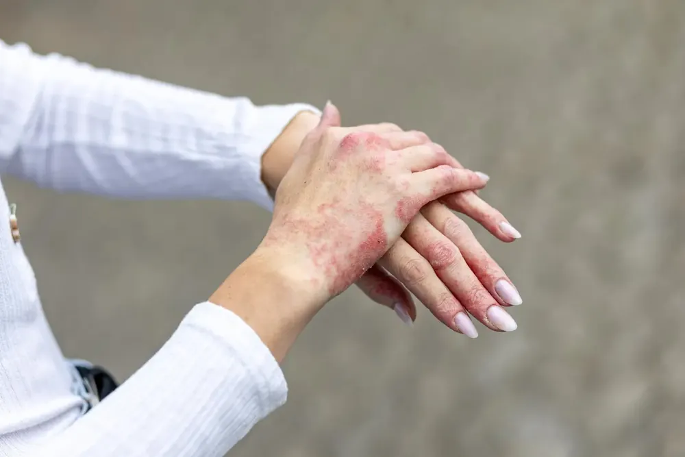 Hands with red, inflamed eczema patches across the backs and fingers