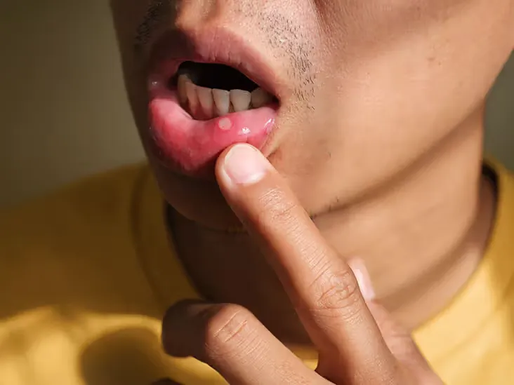 Man pulling down his lower lip to show a mouth ulcer
