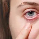 Red, inflamed eye