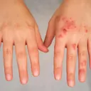 Impetigo on the skin