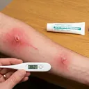Infected insect bite